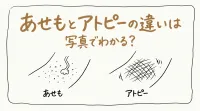 あせもとアトピーの違いは写真でわかる？