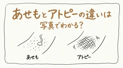 あせもとアトピーの違いは写真でわかる？