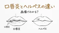 口唇炎とヘルペスの違いは画像でわかる？
