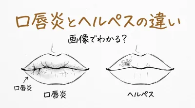 口唇炎とヘルペスの違いは画像でわかる？