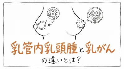 乳管内乳頭腫と乳がんの違いとは？