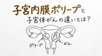 子宮内膜ポリープと子宮体がんの違いとは？