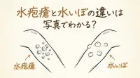 水疱瘡と水いぼの違いは写真でわかる？