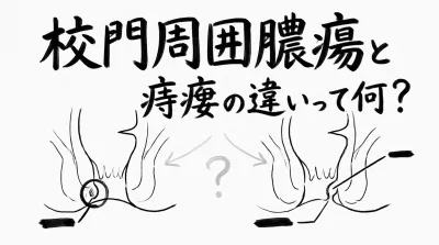 校門周囲膿瘍と痔瘻の違いって何？