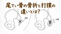 尾てい骨の骨折と打撲の違いとは？