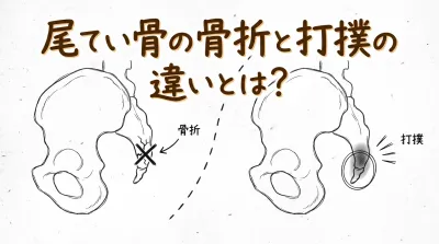 尾てい骨の骨折と打撲の違いとは？